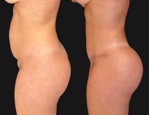 lipo-img-