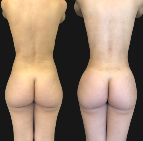 -lipo-o3